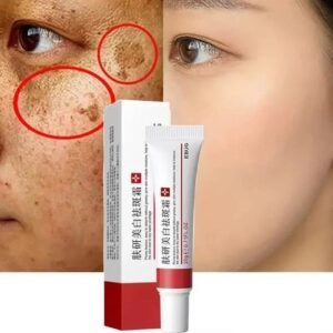 Sunburn, Dark Spots & Freckles Removal Cream