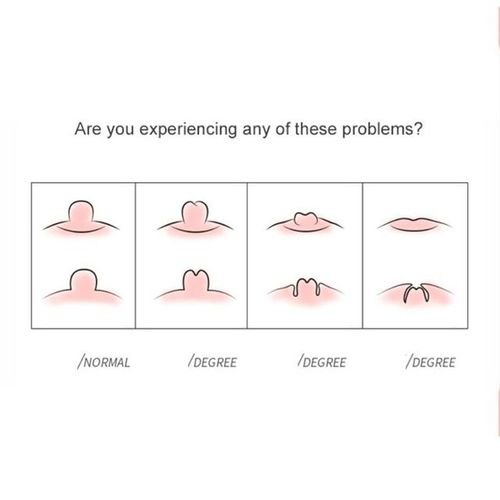 Correcter Aspirator Puller Retraction Pump Teat Massager Corrector Portable Women Orthotics Mum Health Care